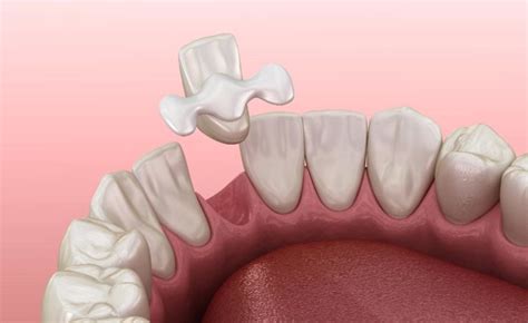 maryland bridge front tooth